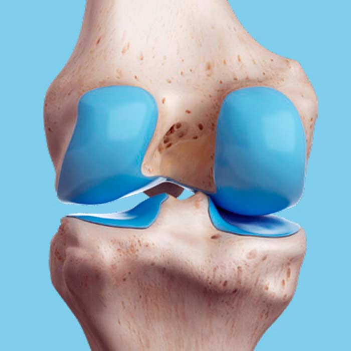 Lesión del Cartílago de Rodilla