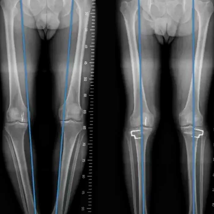 Osteotomía de Rodilla