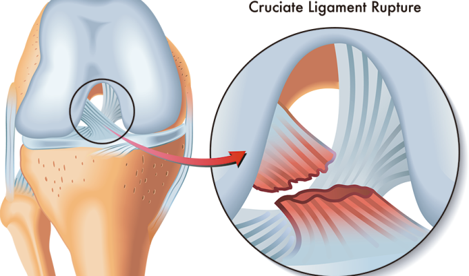 ruptura-del-ligamento-anterior-cruzado